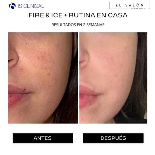 Antes y después de una piel con tendencia acnéica tratada con 🔥FIRE&ICE🧊 en cabina y prescripción de productos iS CLINICAL en casa para ayudar a minimizar la apariencia de las imperfecciones, desatascar poros y eliminar acumulación de sebo obteniendo resultados visibles en menos de dos semanas✨💞

💙Cleansing complex🧡
💙Active sérum
💙Hydra-cool serum🧡
💙Active peel system (en días alternos)
🧡Pro-heal sérum
🧡Eclipse 50SPF

No dudes en agendar cita para un diagnóstico facial gratuito y mejorar la salud y apariencia de tu piel💆🏻‍♀️

🌍C/Rossellò 180, 08008 BCN
📱608 580 263
👩🏻‍💻www.elsalonbyaurainsitut.com

💙Noche
🧡Día

#acné #pielacneica #isclinical #salud #belleza #botanico #cosmeceutica #skincare #skincareroutine
